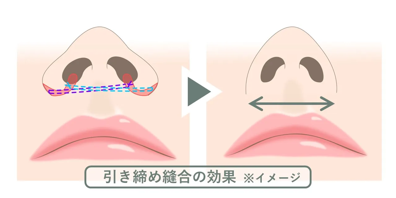 小鼻縮小のオプション手術【引き締め縫合】では、皮下に糸を埋め込み引き寄せることで、小鼻の横幅を縮小します。