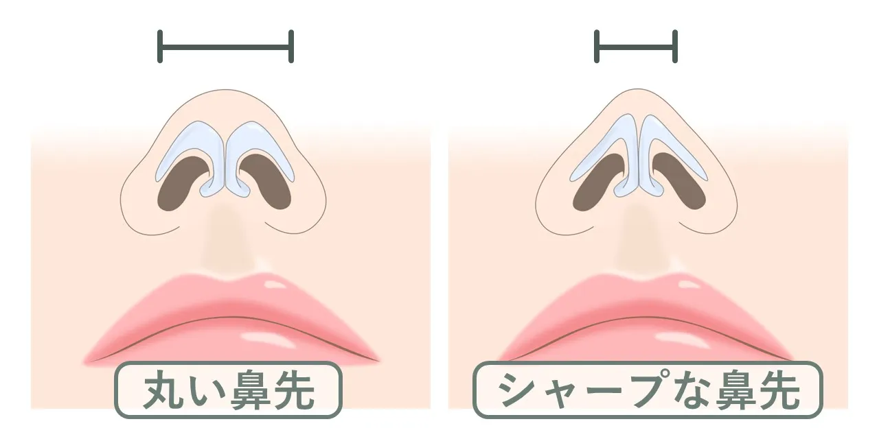 丸い鼻先とシャープな鼻先における鼻翼軟骨の形状の違い