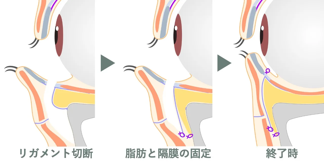 裏ハムラ（経結膜的眼窩脂肪移動術）の手術イメージ｜ティアトラフを頬骨から離断したのち、眼窩隔膜を解放し、眼窩脂肪と眼窩隔膜を尾側に牽引固定後、結膜を縫合糸て手術を終了する図