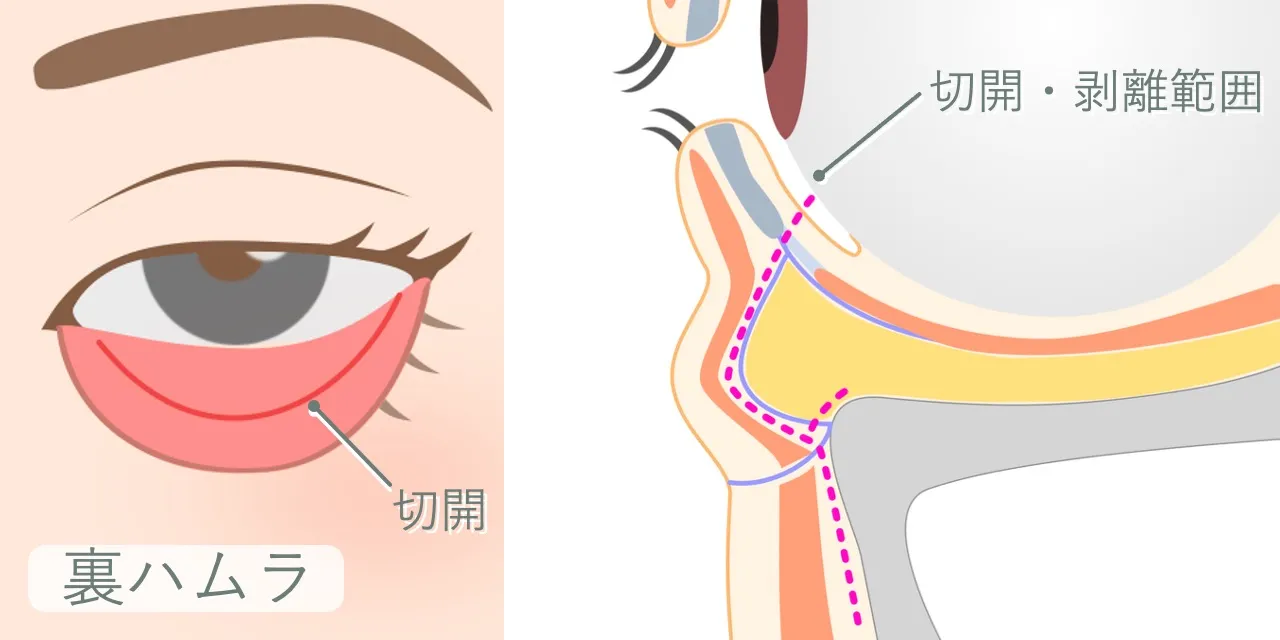 裏ハムラ（経結膜的眼窩脂肪移動術）の手術イメージ｜下まぶたの粘膜の切開位置と、眼輪筋、眼窩脂肪、ティアトラフへのアプローチ経路