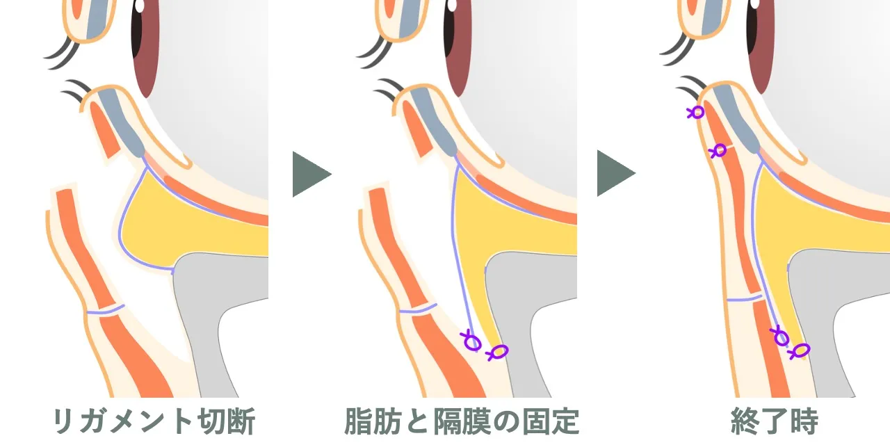 表ハムラ（経皮的眼窩脂肪移動術）の手術イメージ｜余剰皮膚を切除してティアトラフを頬骨から離断したのち、眼窩隔膜を解放し、眼窩脂肪と眼窩隔膜を尾側に牽引固定後、皮膚を縫合して手術を終了する図