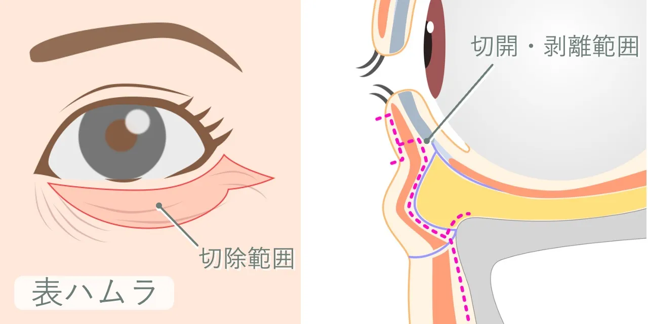 表ハムラ（経皮的眼窩脂肪移動術）の手術イメージ｜皮膚の切除範囲と眼輪筋、眼窩脂肪、ティアトラフへのアプローチ経路