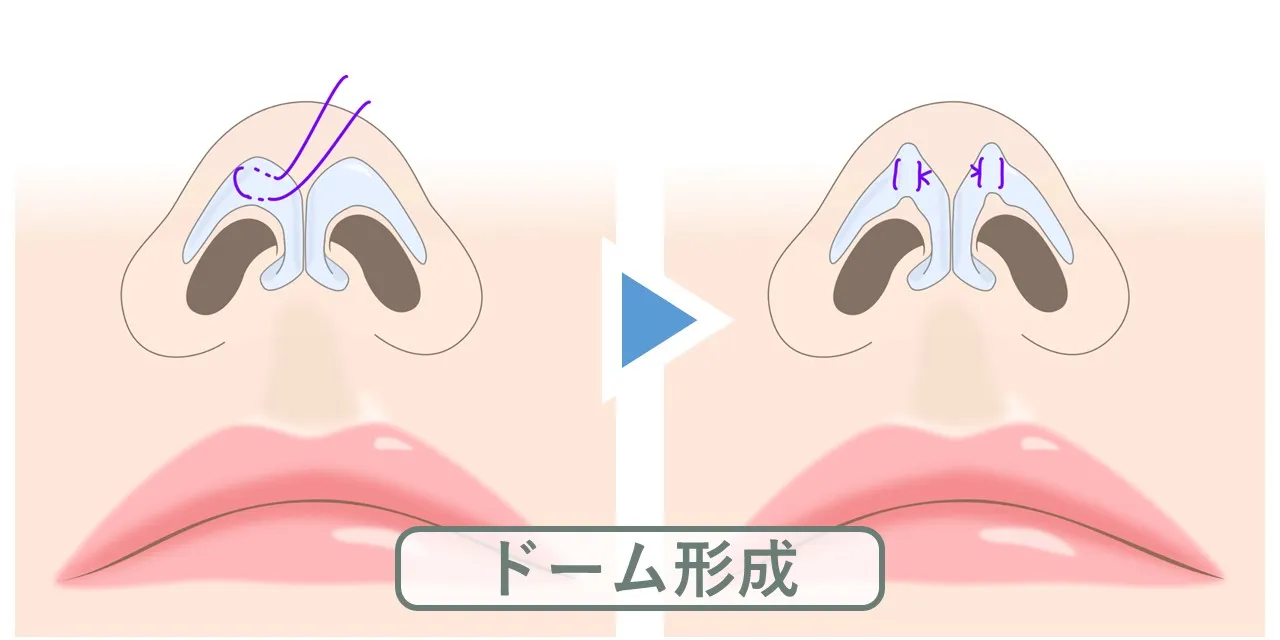鼻尖形成術におけるドーム形成transdomal sutureの縫合方法