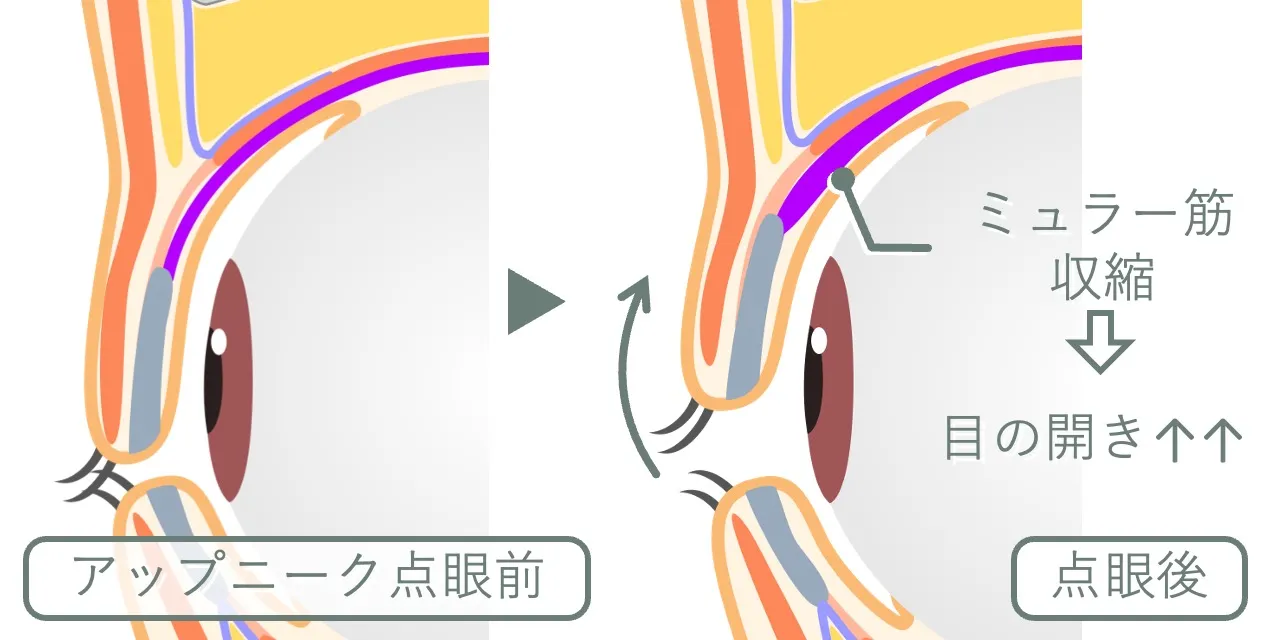 アップニークの効果のメカニズム｜アップニークはミュラー筋に作用して瞼板を挙上する