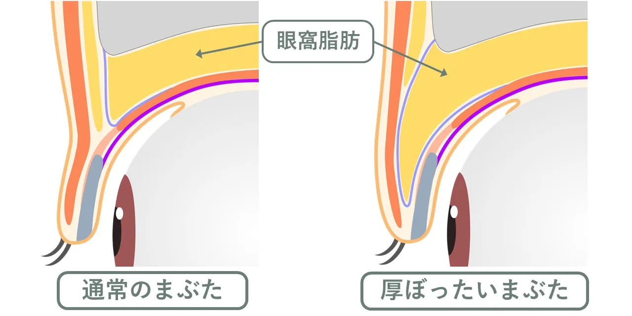 上まぶたの脂肪（眼窩脂肪）が多く、上まぶたの重さの原因になっている状態
