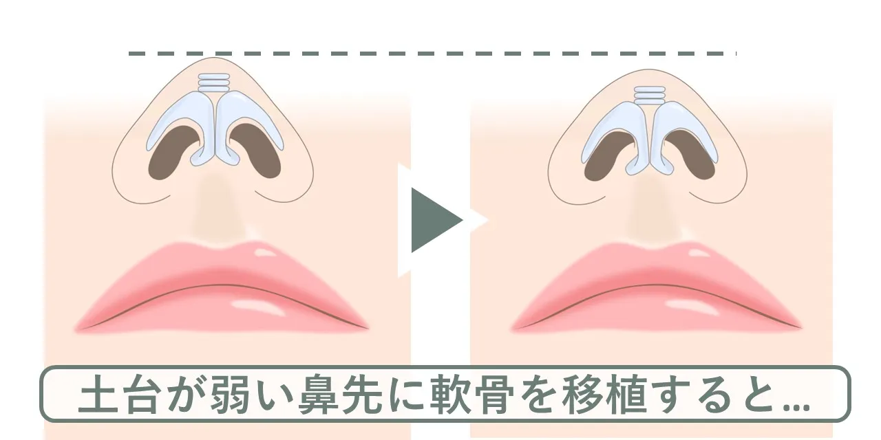 鼻尖に移植軟骨を重ねても、鼻翼軟骨の土台が弱いと鼻先は沈んでしまうので、補強が必要です