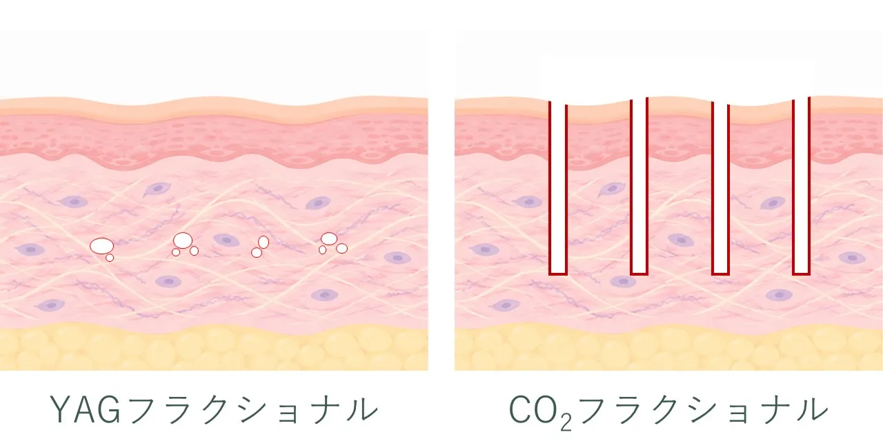 組織像で比較するYAGフラクショナルレーザーとCO2フラクショナルレーザーの違い｜ノンアブレーティブとアブレーティブ