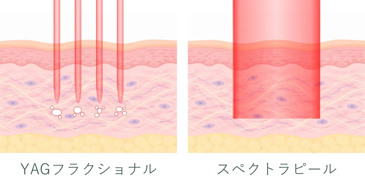 YAGフラクショナルレーザーとスペクトラピールの比較イメージ