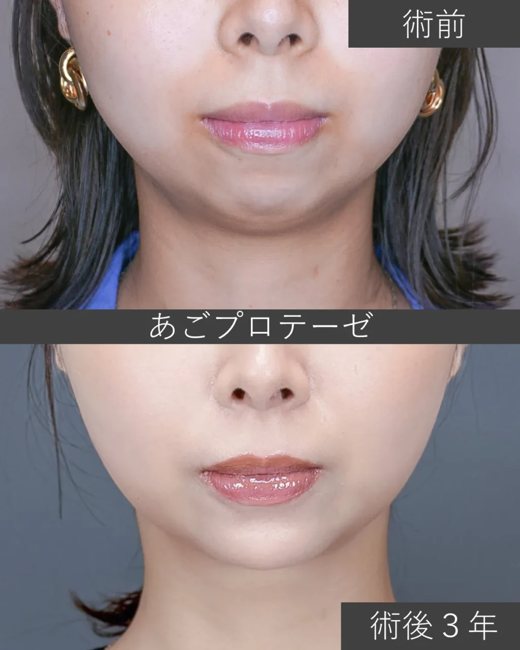 あごプロテーゼの症例写真｜施術前と施術後3年の正面像