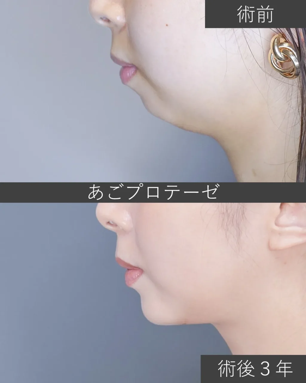 あごプロテーゼの症例写真｜施術前と施術後3年の側面像