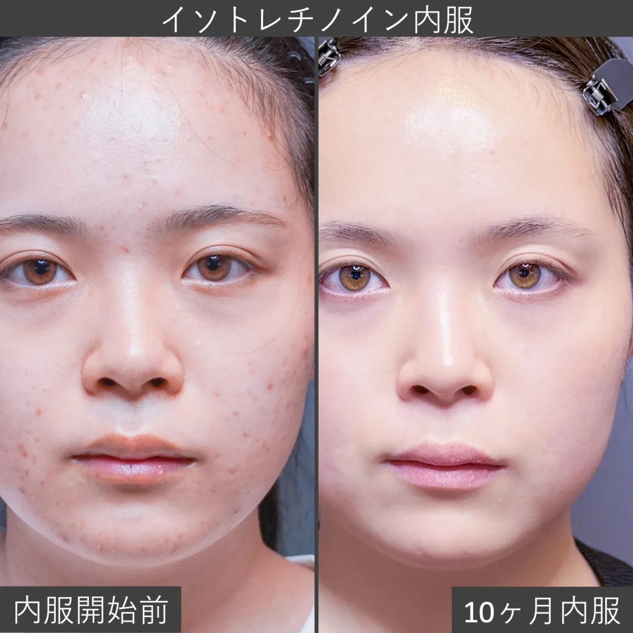 イソトレチノイン内服の症例写真｜内服開始前と計10ヶ月分内服終了後の正面像