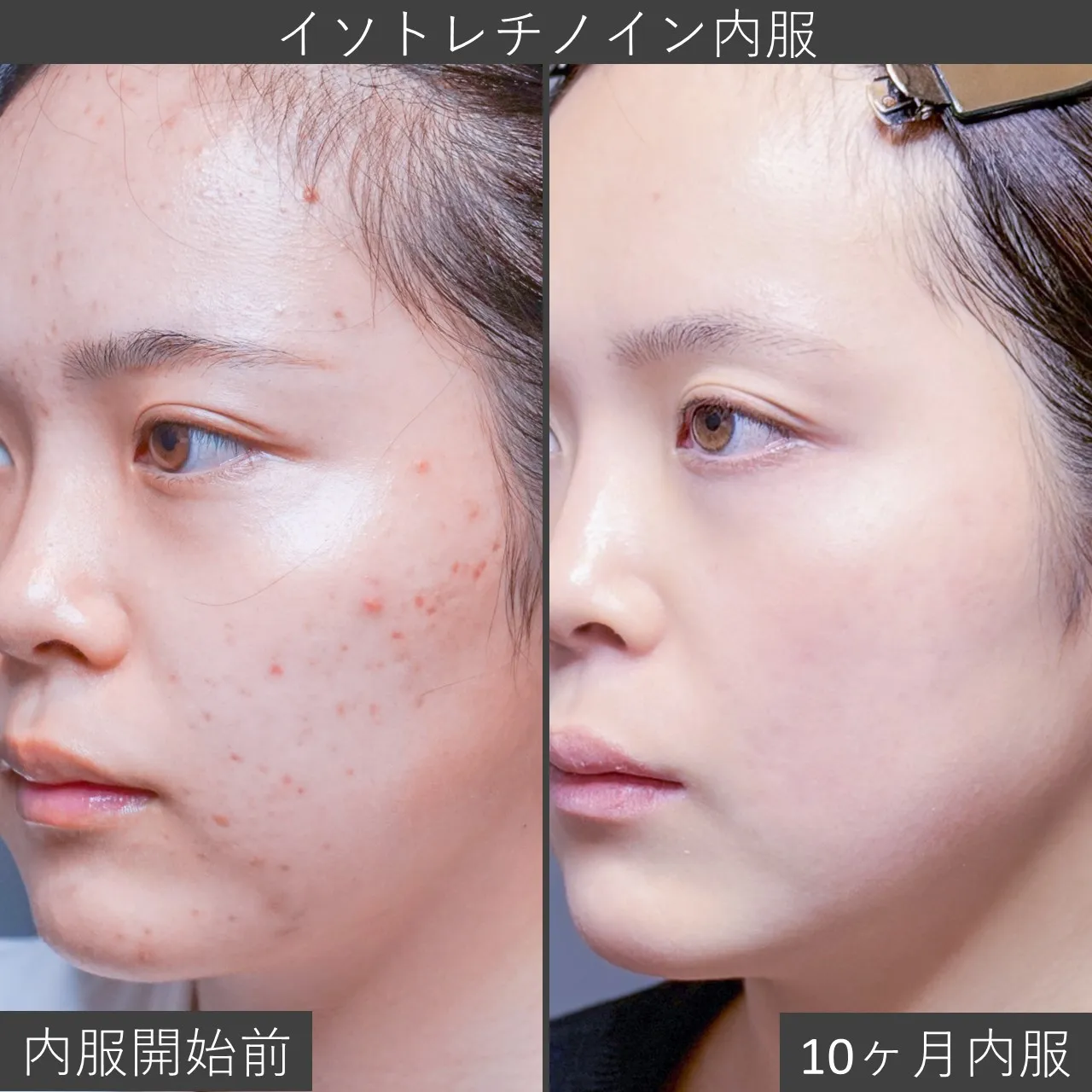 イソトレチノイン内服の症例写真|内服開始前と計10ヶ月分内服終了後の斜位像