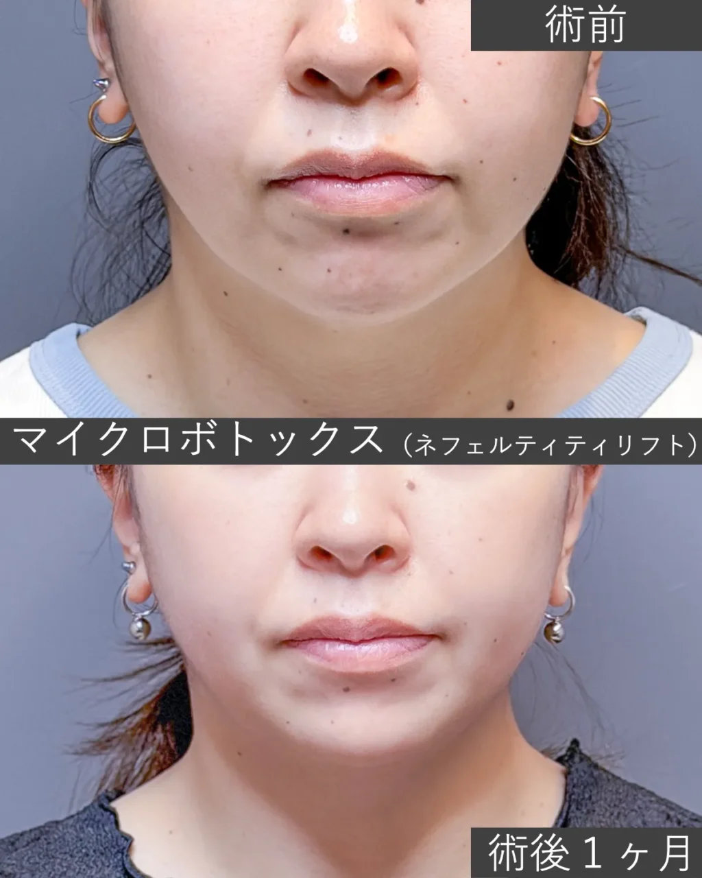 マイクロボトックスの症例写真｜施術前と施術後１ヶ月の正面像