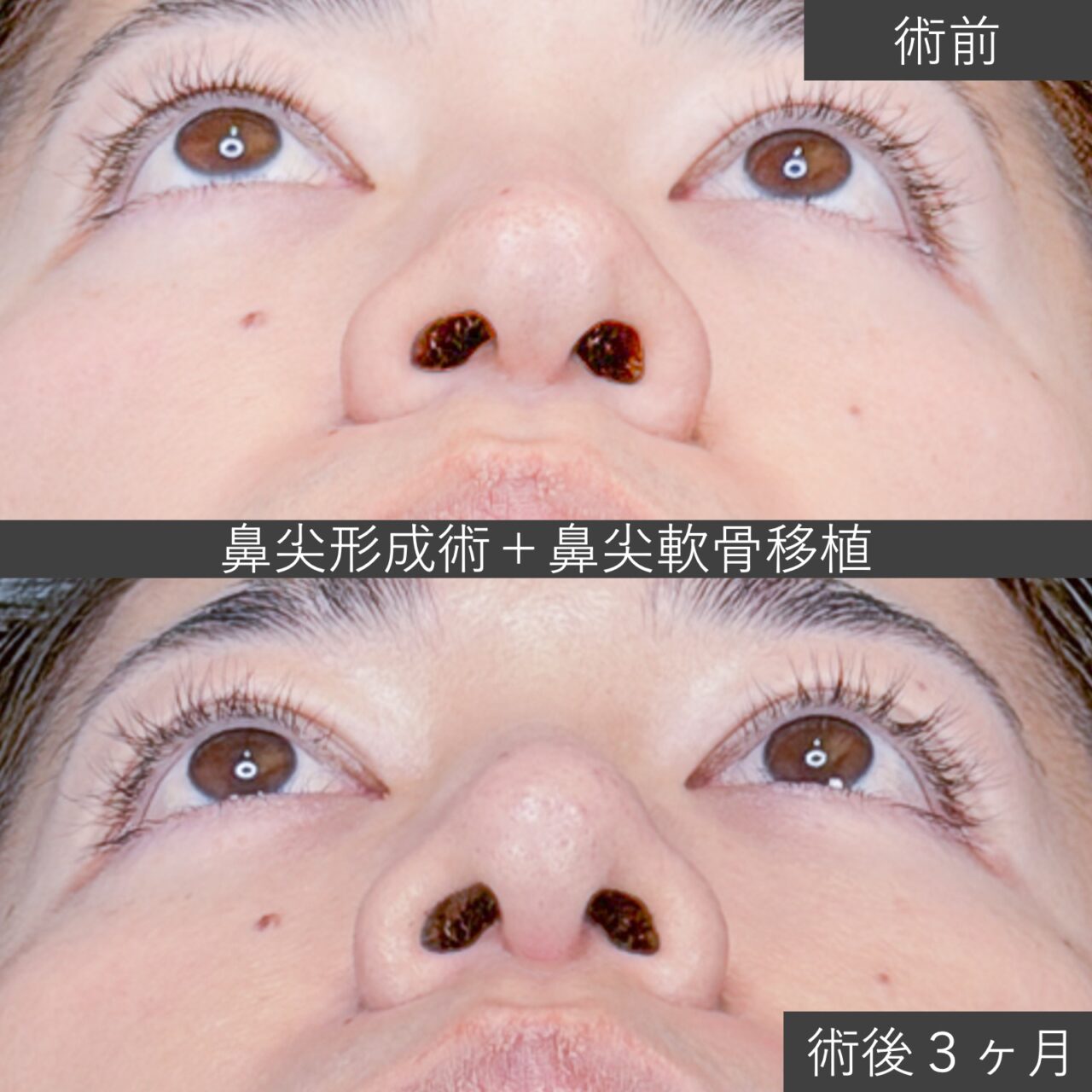 鼻尖形成術＋鼻尖軟骨移植術の症例写真｜施術前と施術後３ヶ月のあおり