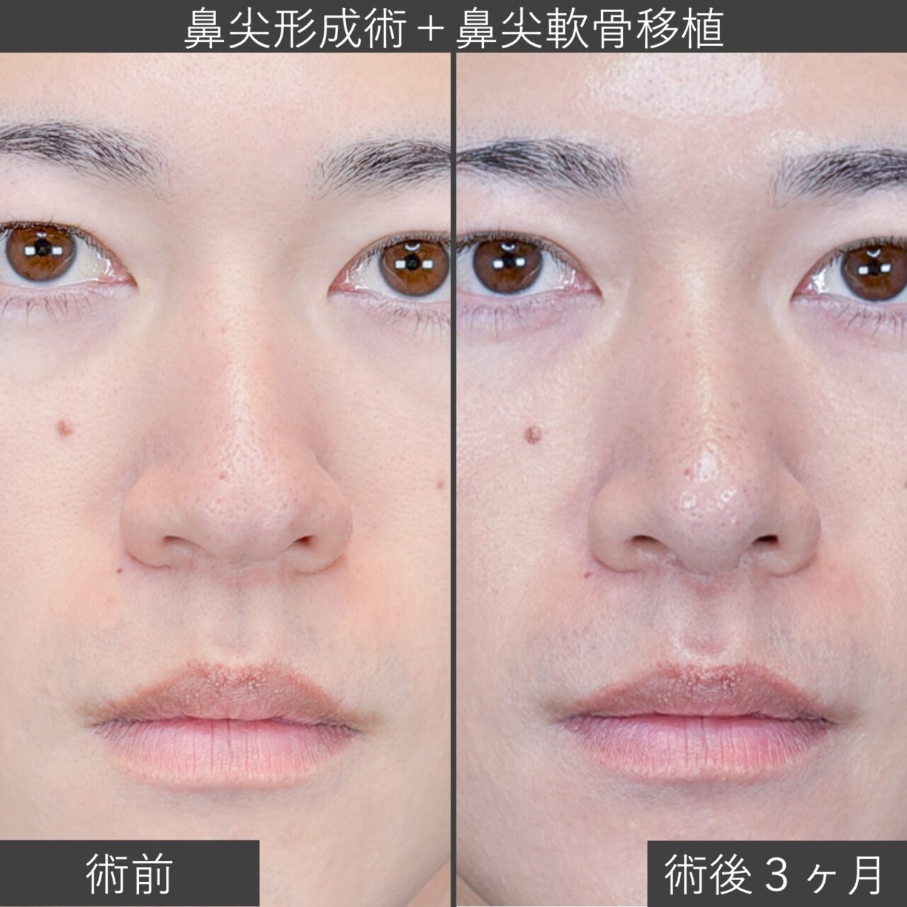 鼻尖形成術＋鼻尖軟骨移植術の症例写真｜施術前と施術後３ヶ月の正面像