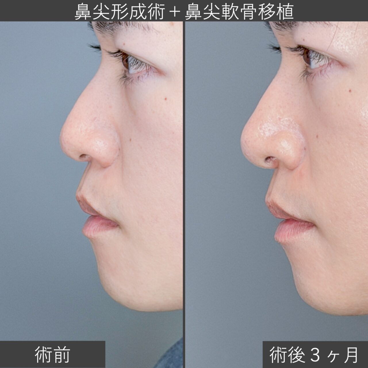 鼻尖形成術＋鼻尖軟骨移植術の症例写真｜施術前と施術後３ヶ月の側面像